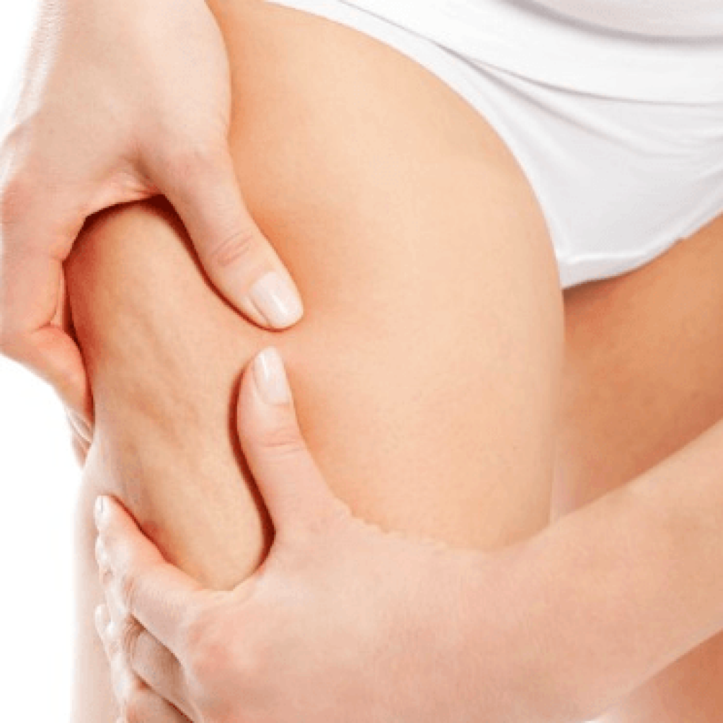 How to Treat Cellulite